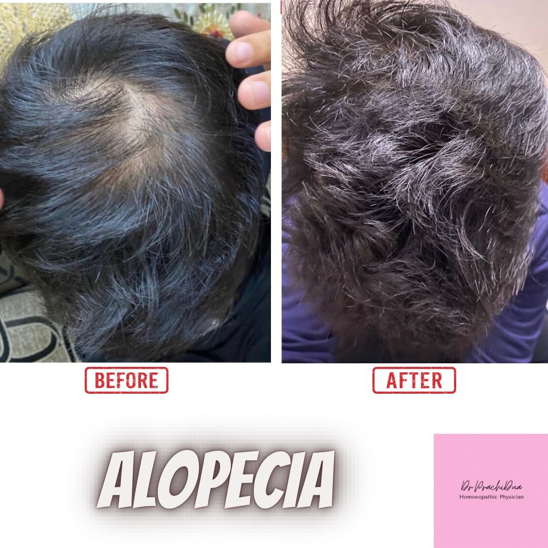 Alopecia — documented before and after (shared with consent)