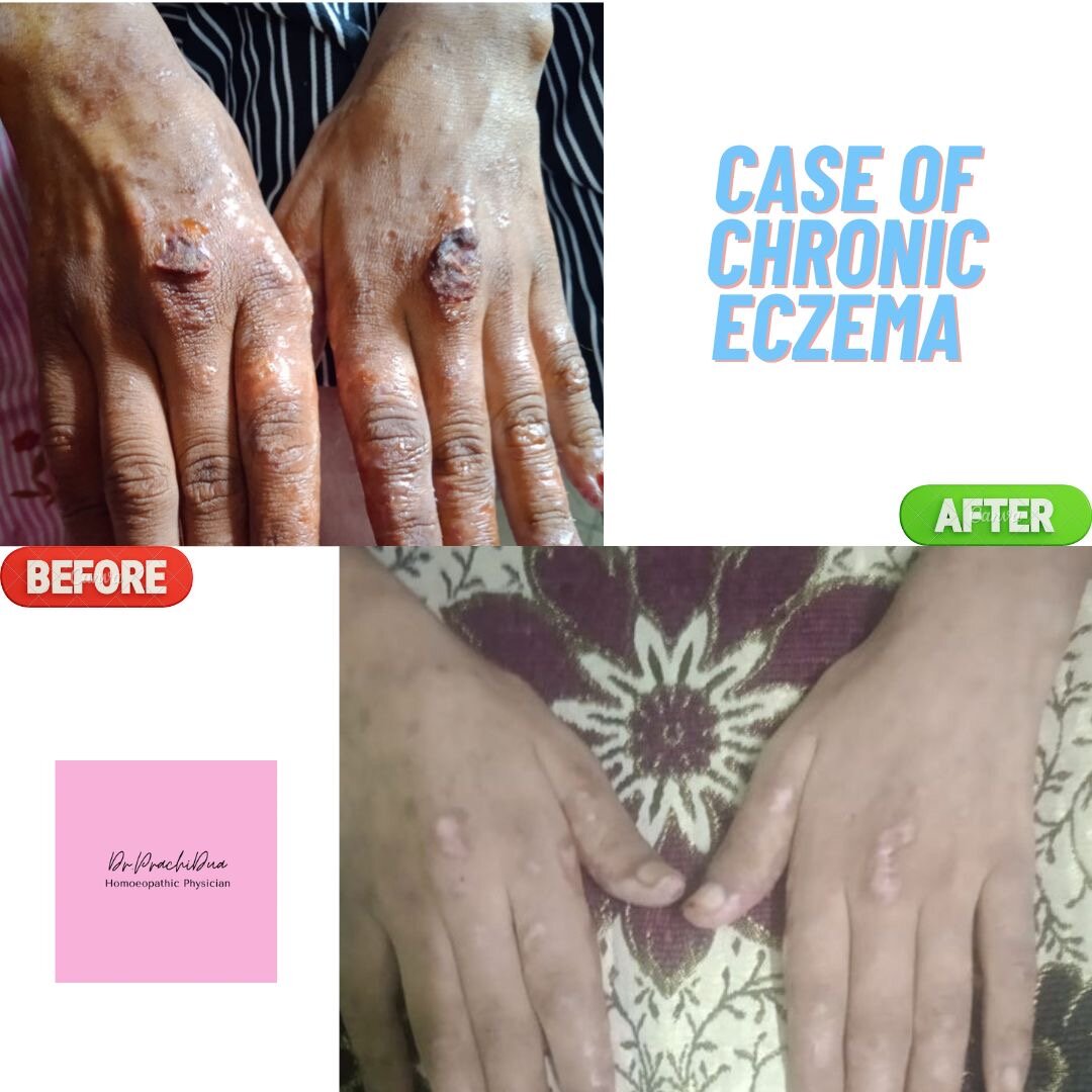 Chronic eczema — documented before and after (shared with consent)